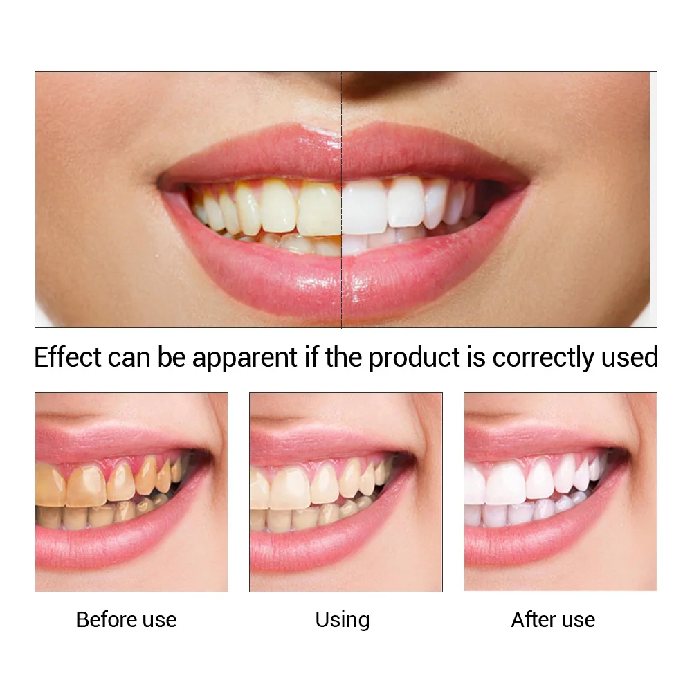 FTEENPLY 치아 미백 에센스 파우더 구강 위생 청 - Teeth Whitening From Home 리뷰 및 가격