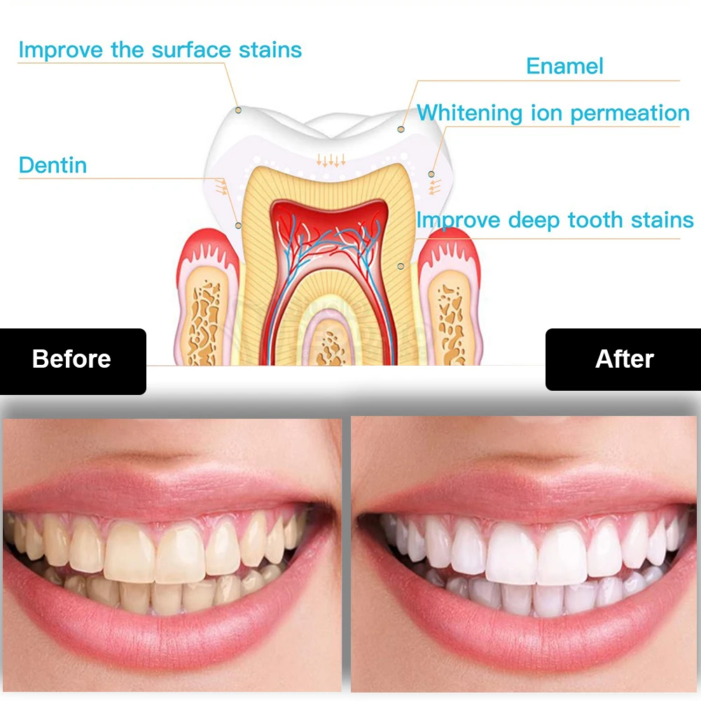 치과 치아 미백 키트 미니 16 LED 콜드 라이트 3 - Teeth Whitening From Home 리뷰 및 가격
